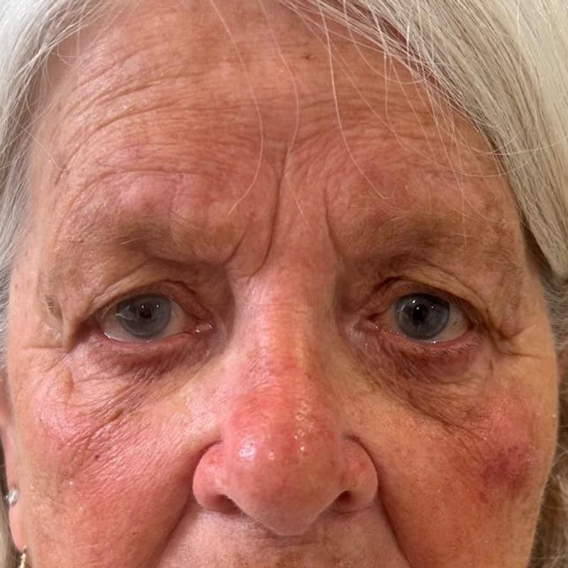 The same client's face and under-eye area after polynucleotide treatment