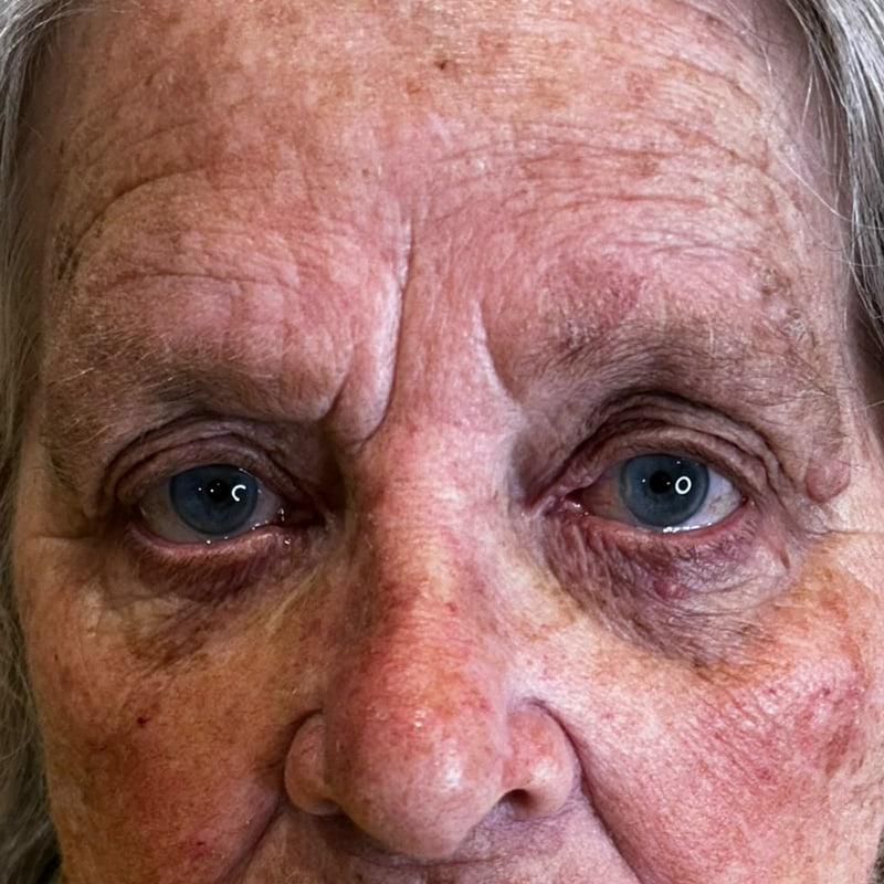 Client's face and under-eye area before polynucleotide treatment