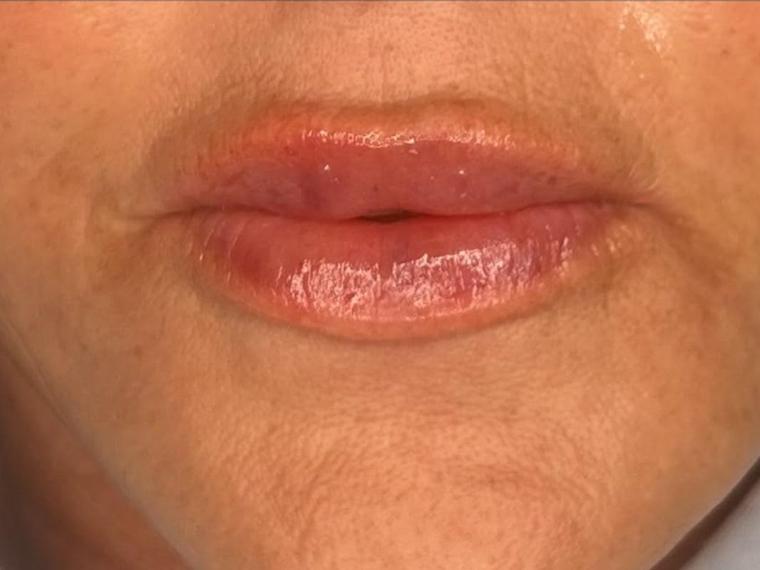 The same client's lips and marionette lines after lip and marionette line filler