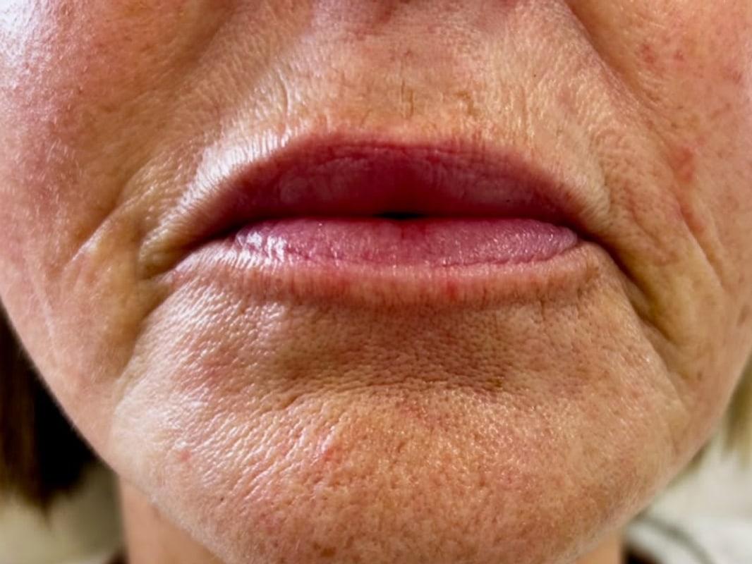 Close-up of a client's lips and marionette lines before treatment