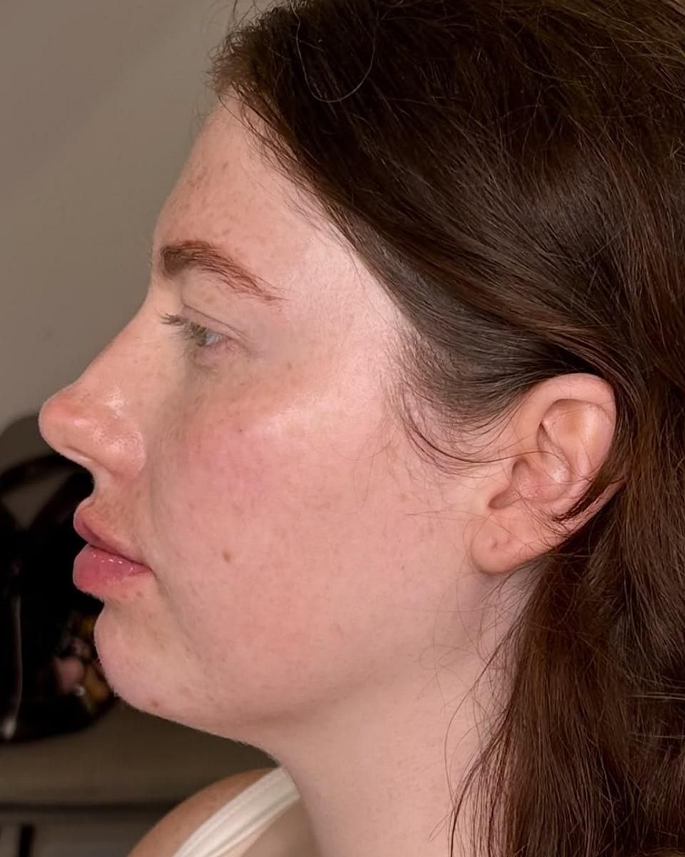 The same client's side profile after lip and cheek filler