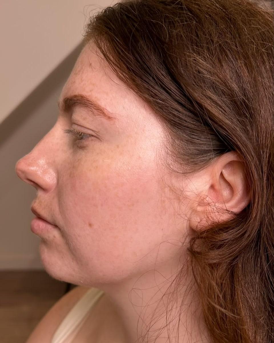 Side profile of a client's lips and cheek before lip and cheek filler